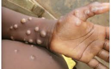 Western North Region Health directorate has reported confirmed Mpox cases
